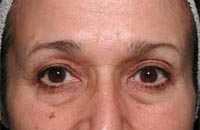 picture eyebrows after thermage brow lift