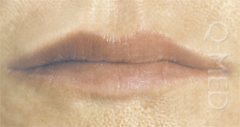 lips after restylane
