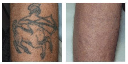 Laser Tattoo Removal Arizona | Perfect Skin Laser Center LLC AZ