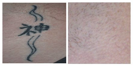 Laser Tattoo Removal Arizona | Perfect Skin Laser Center LLC AZ