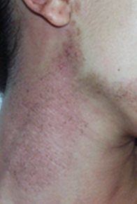 Laser birthmark removal, Laser Birthmark Removal