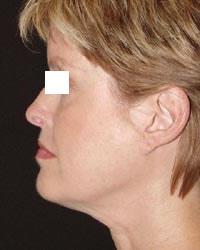 picture after thermage face lift