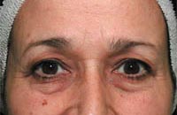 picture eyebrows before thermage brow lift