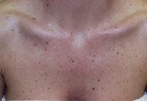 picture chest before fotofacial IPL