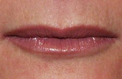 lips after restylane