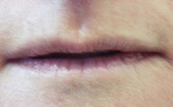 lips before restylane