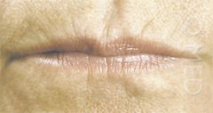 lips before restylane
