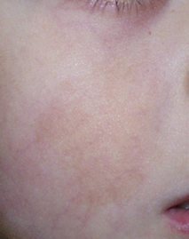 Laser birthmark removal, Laser Birthmark Removal