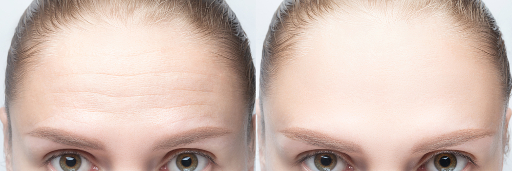 Understanding What Causes Forehead Wrinkles | Perfect Skin Center
