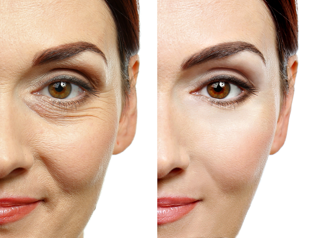 How to Get Rid of Wrinkles Under Your Eyes | Perfect Skin Center