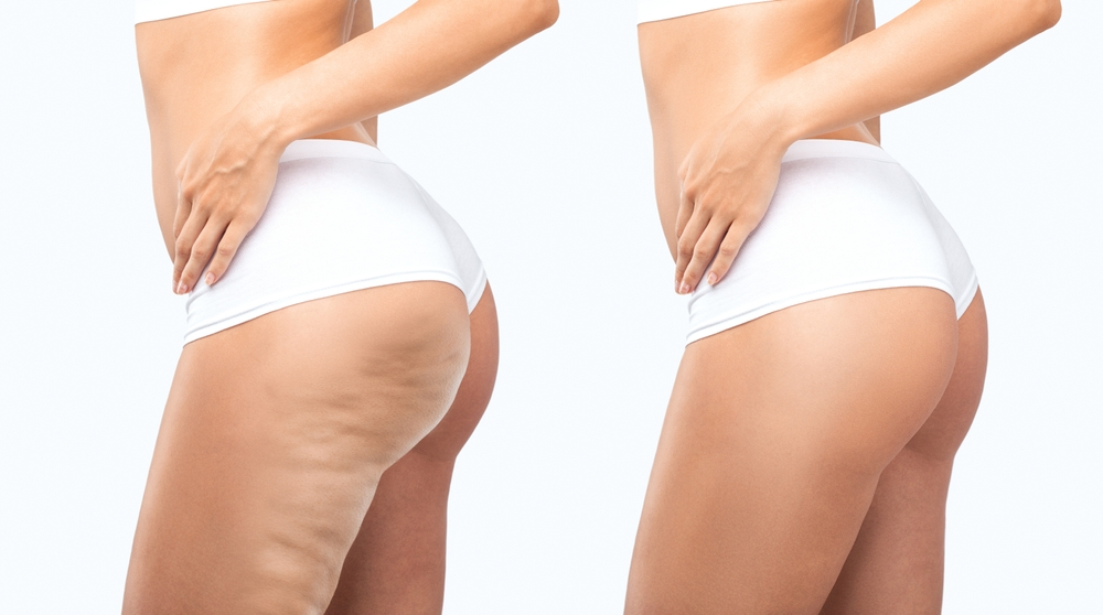 The Mental Health Benefits of Cellulite Reduction | Perfect Skin Center