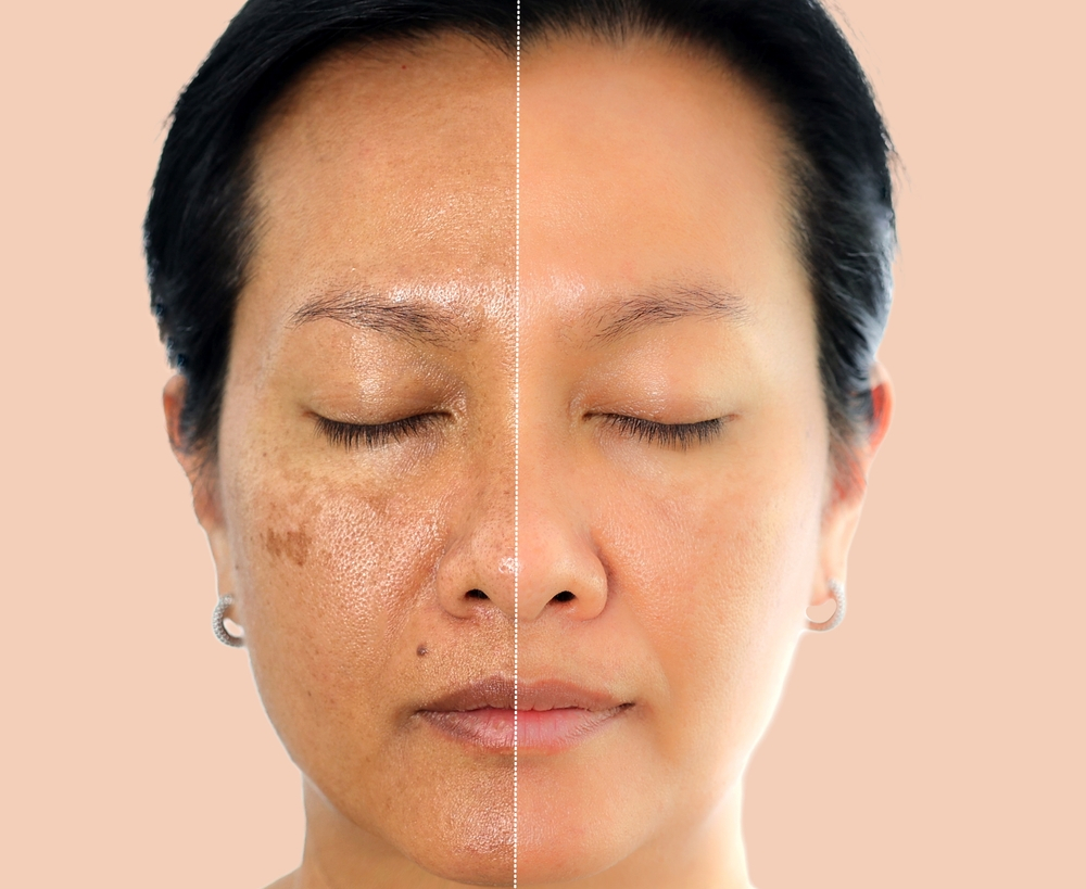 Sun Exposure Contribute to Skin Laxity | Perfect Skin Center