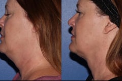 A woman before and after accutite treatment