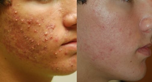 A before and after acne scar removal treatment photo.