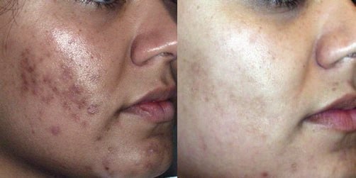 A woman before and after acne scar removal treatment