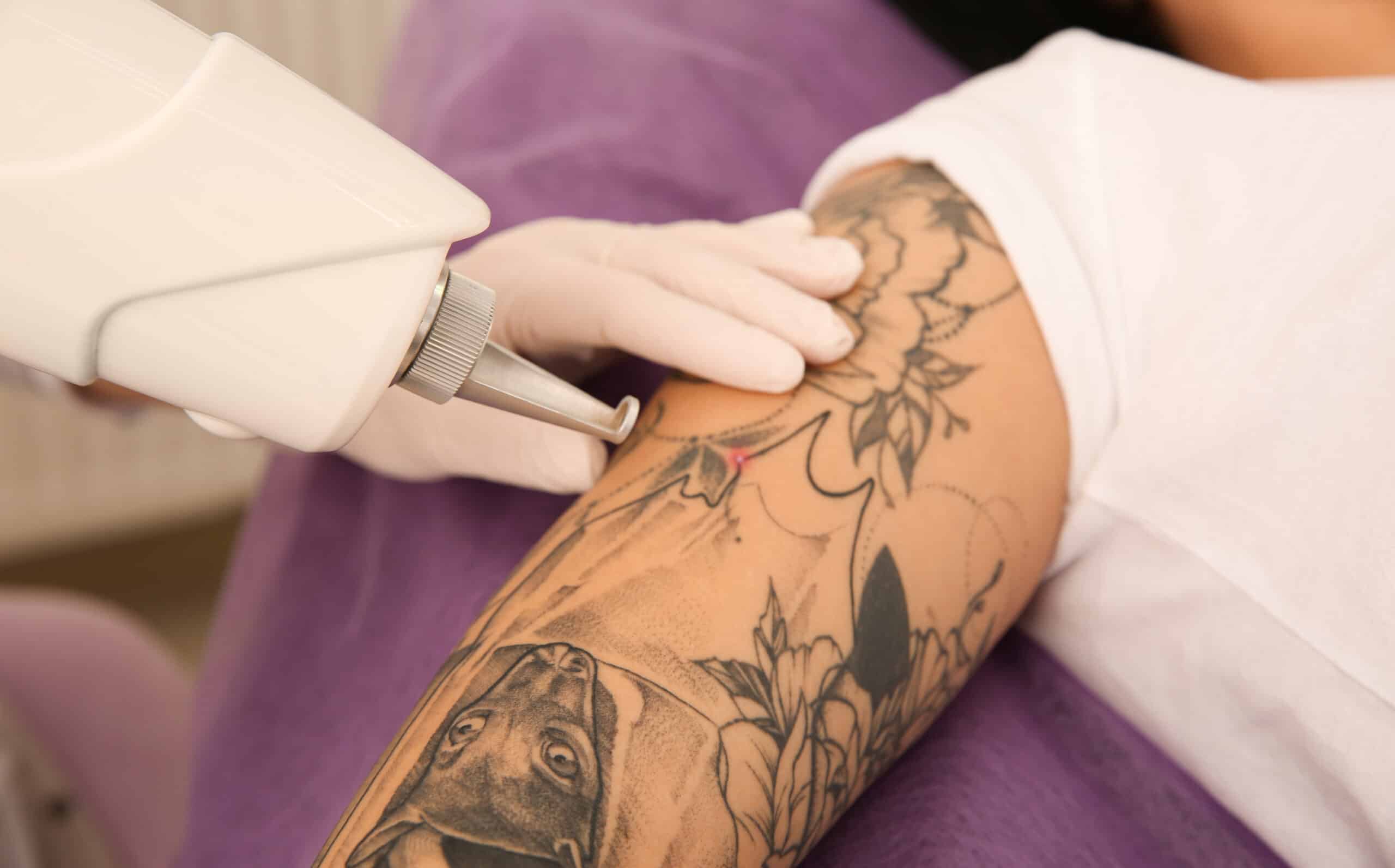 Laser Tattoo Removal Arizona | Perfect Skin Laser Center LLC AZ