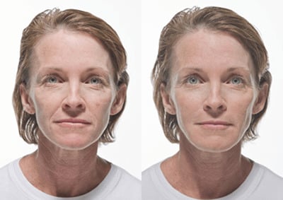 A woman before and after Radiesse treatment