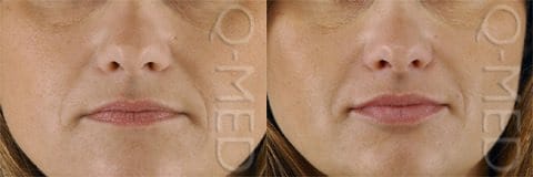 A woman before and after restylane treatment