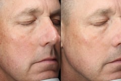 A man before and after Sciton Halo laser treatment