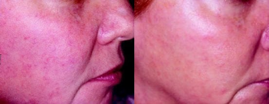 A woman's face before and after levulan treatment