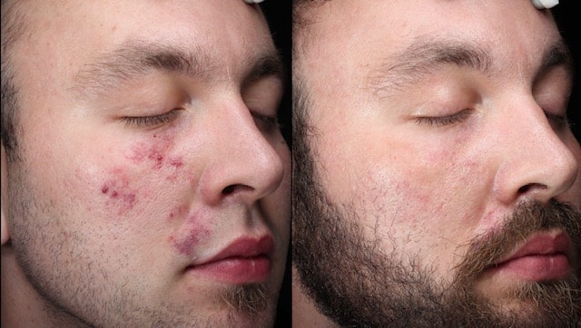 A man's face before and after laser birthmark removal