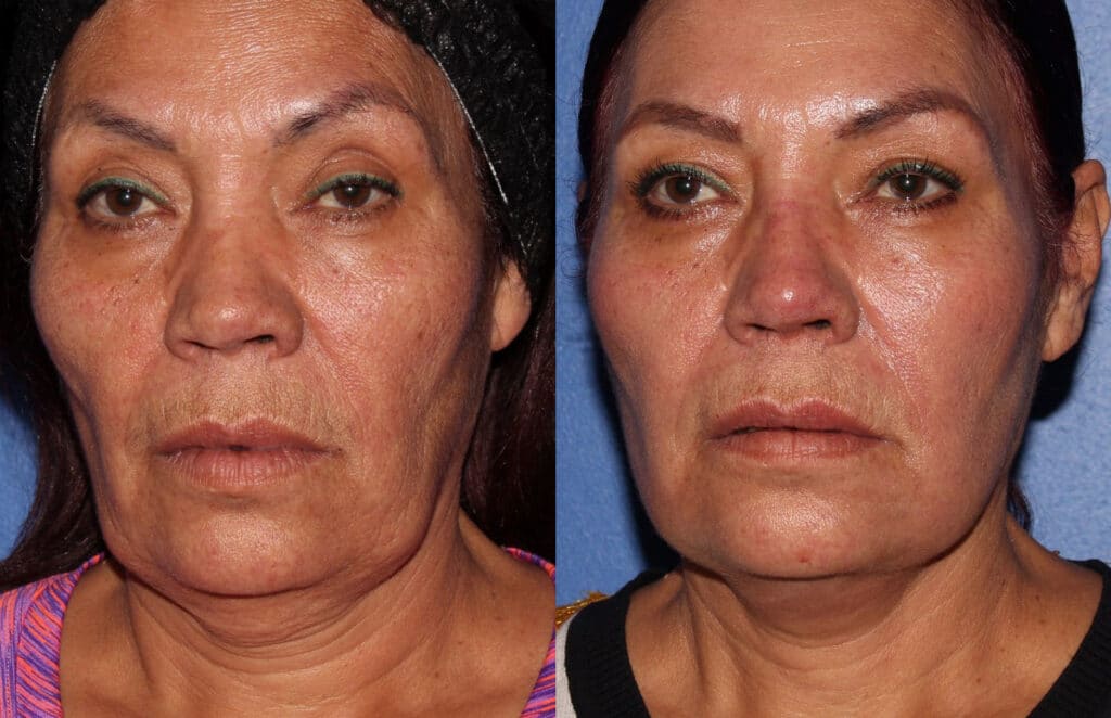 A woman's face before and after facetite treatment