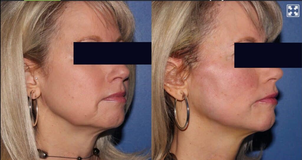 A woman's face before and after a PDO threadlift
